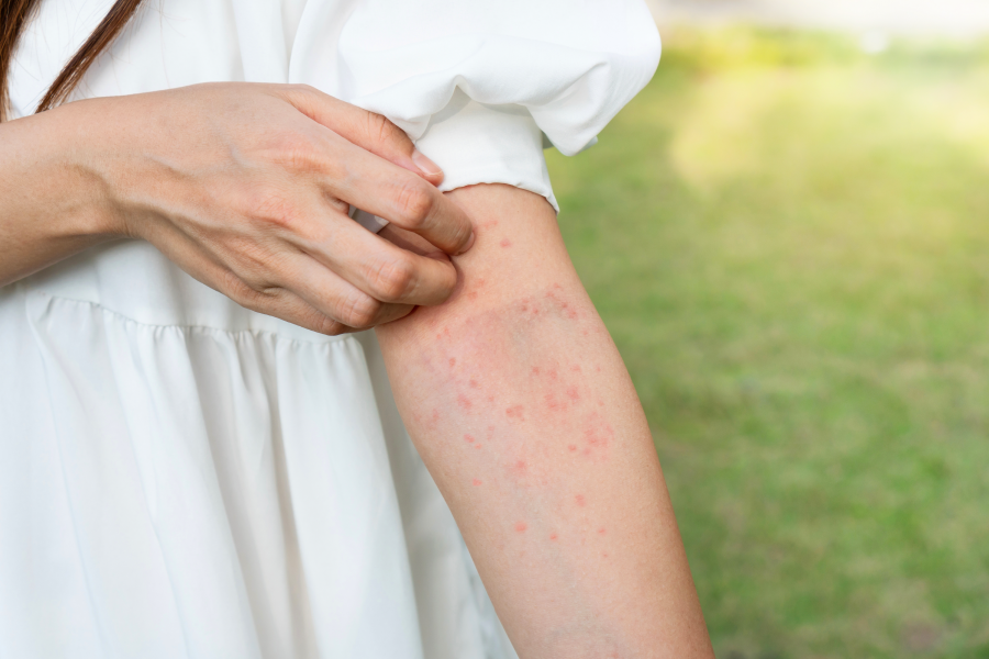 Got heat rash? Here's how to identify and treat the condition