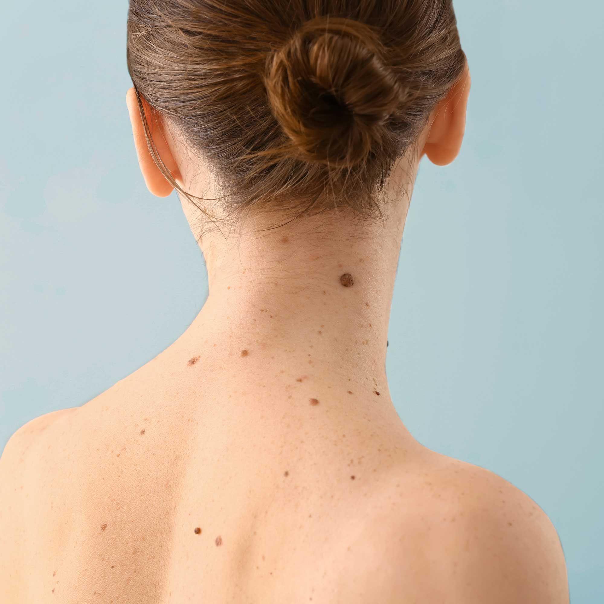 The Ev Guide To Skin Tags Etre Vous